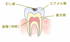 C1【エナメル質の虫歯】